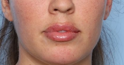 Lip Filler Before & After Patient #33269