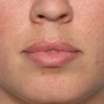 Lip Filler Before & After Patient #33269