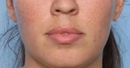 Lip Filler Before & After Patient #33269