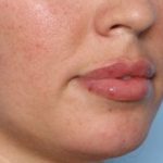 Lip Filler Before & After Patient #33269