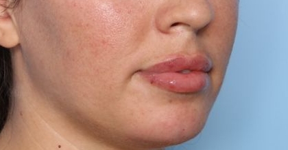 Lip Filler Before & After Patient #33269