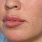Lip Filler Before & After Patient #33269