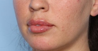 Lip Filler Before & After Patient #33269