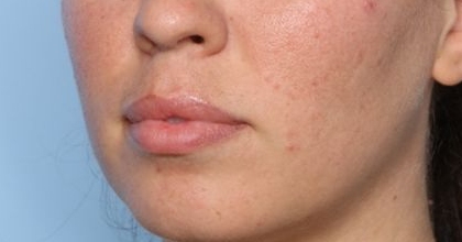 Lip Filler Before & After Patient #33269