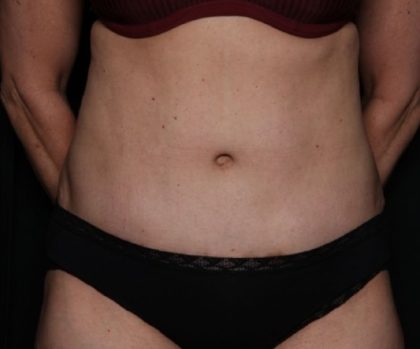 Tummy Tuck Before & After Patient #33297