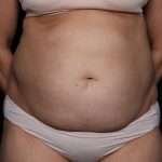 Tummy Tuck Before & After Patient #33297