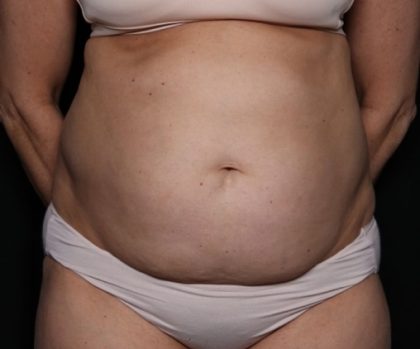 Tummy Tuck Before & After Patient #33297