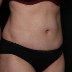 Tummy Tuck Before & After Patient #33297