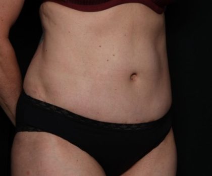 Tummy Tuck Before & After Patient #33297