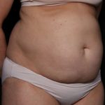 Tummy Tuck Before & After Patient #33297