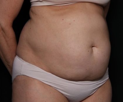 Tummy Tuck Before & After Patient #33297