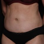 Tummy Tuck Before & After Patient #33297
