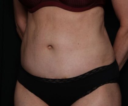 Tummy Tuck Before & After Patient #33297