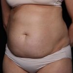 Tummy Tuck Before & After Patient #33297