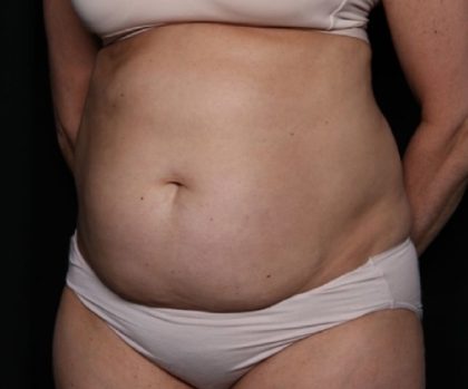 Tummy Tuck Before & After Patient #33297