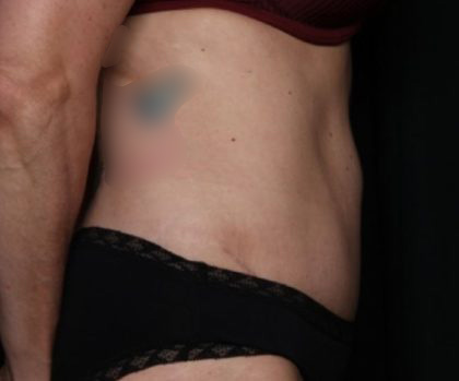 Tummy Tuck Before & After Patient #33297