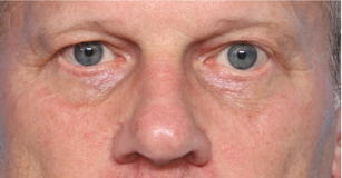 Blepharoplasty Before & After Patient #33310