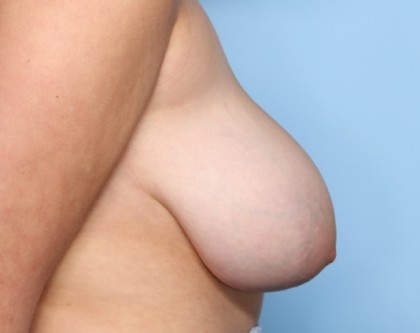 Breast Reduction Before & After Patient #33339