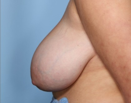 Breast Reduction Before & After Patient #33339
