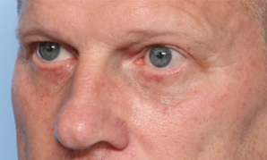 Blepharoplasty Before & After Patient #33310