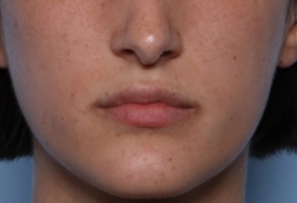 Lip Filler Before & After Patient #33379