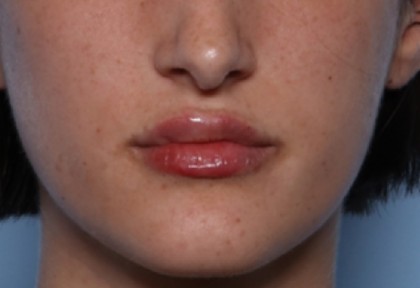 Lip Filler Before & After Patient #33379