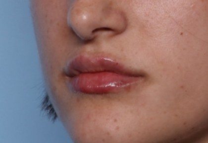 Lip Filler Before & After Patient #33379