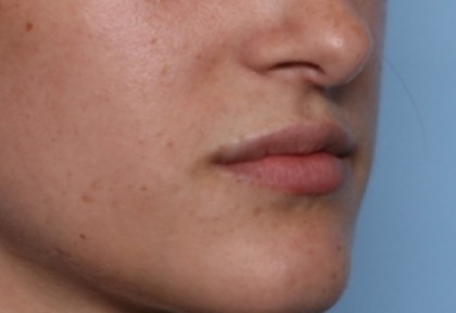 Lip Filler Before & After Patient #33379