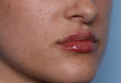 Lip Filler Before & After Patient #33379
