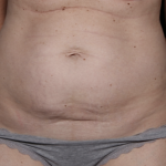 Tummy Tuck Before & After Patient #33368