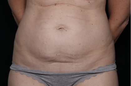 Tummy Tuck Before & After Patient #33368