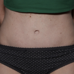 Tummy Tuck Before & After Patient #33368