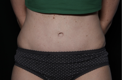 Tummy Tuck Before & After Patient #33368