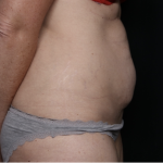 Tummy Tuck Before & After Patient #33368