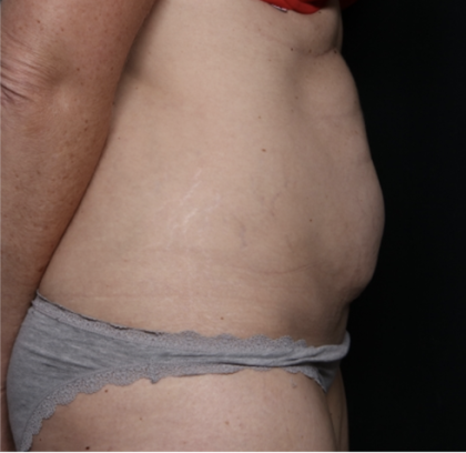 Tummy Tuck Before & After Patient #33368