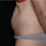 Tummy Tuck Before & After Patient #33368