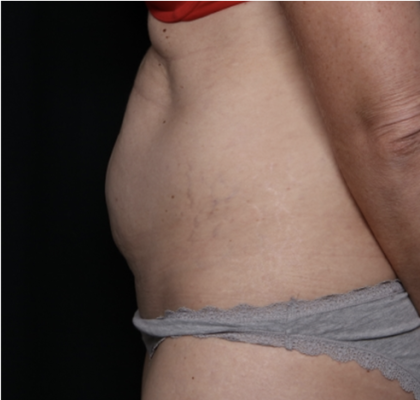 Tummy Tuck Before & After Patient #33368