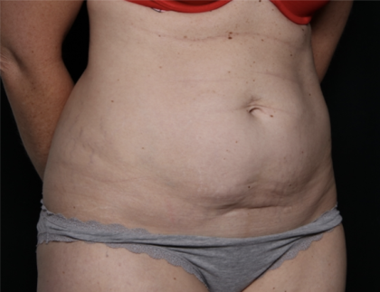 Tummy Tuck Before & After Patient #33368