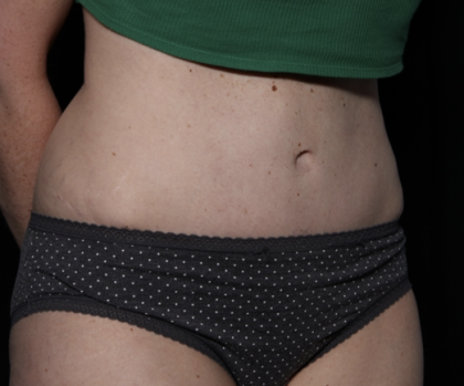 Tummy Tuck Before & After Patient #33368