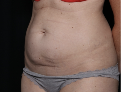 Tummy Tuck Before & After Patient #33368