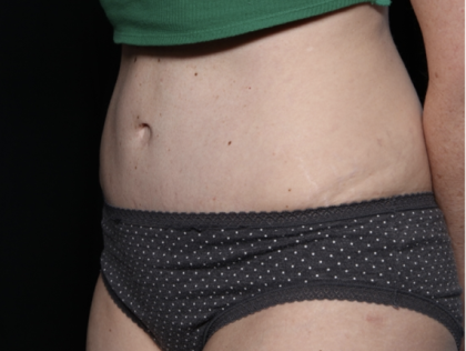 Tummy Tuck Before & After Patient #33368