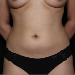 Liposuction Before & After Patient #33350