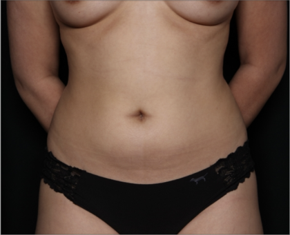 Liposuction Before & After Patient #33350