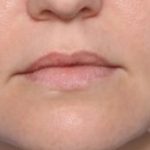 Lip Filler Before & After Patient #33332