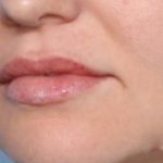 Lip Filler Before & After Patient #33332