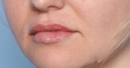Lip Filler Before & After Patient #33332