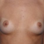 Breast Augmentation Before & After Patient #33406