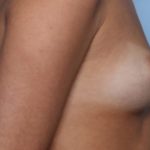 Breast Augmentation Before & After Patient #33406