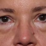 Lower Blepharoplasty Before & After Patient #33418