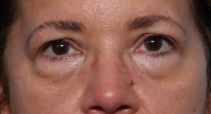 Lower Blepharoplasty Before & After Patient #33418